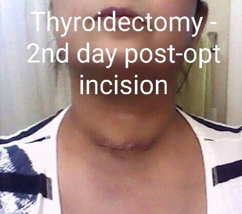 Thyroidectomy 2nd day post-ops incision